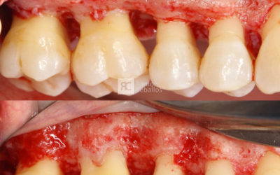 Cirugía osea resectiva por enfermedad periodontal